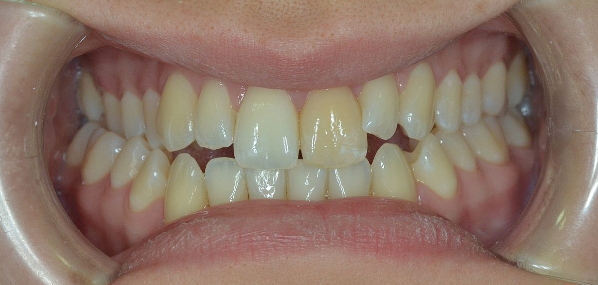 antes ortodoncia invisible Dental Morante
