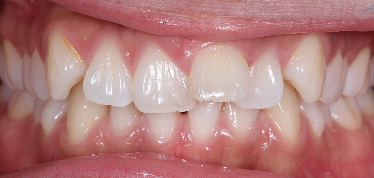 antes ortodoncia invisible Dental Morante