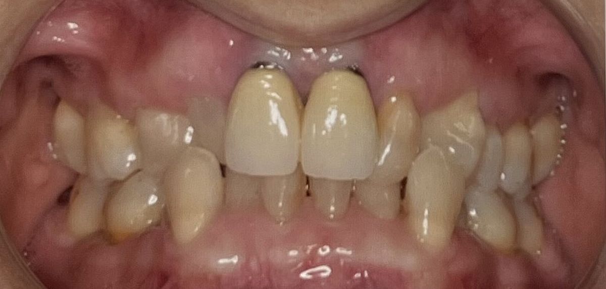antes ortodoncia invisible Dental Morante