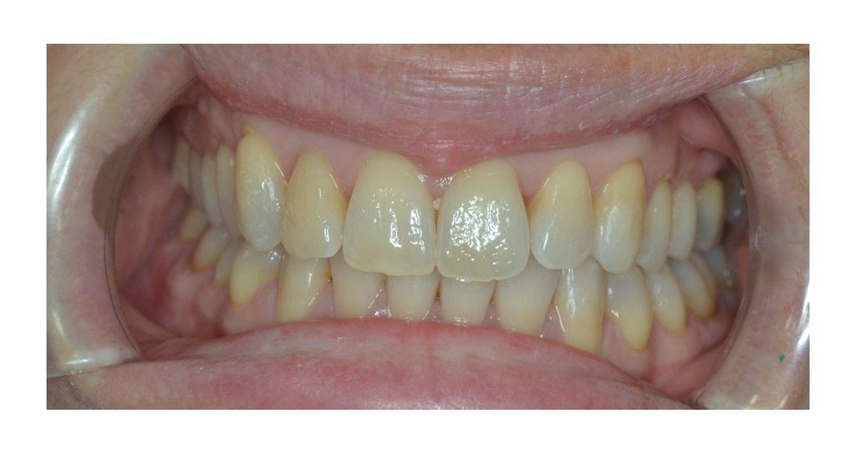 blanqueamiento dental dental morante implantes en madrid