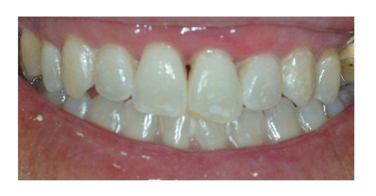 blanqueamiento dental dental morante implantes en madrid
