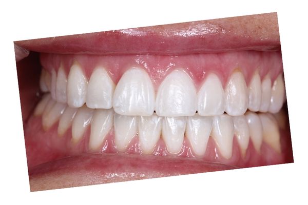 Blanqueamiento dental ¿Sabes en qué consiste? Recomendaciones