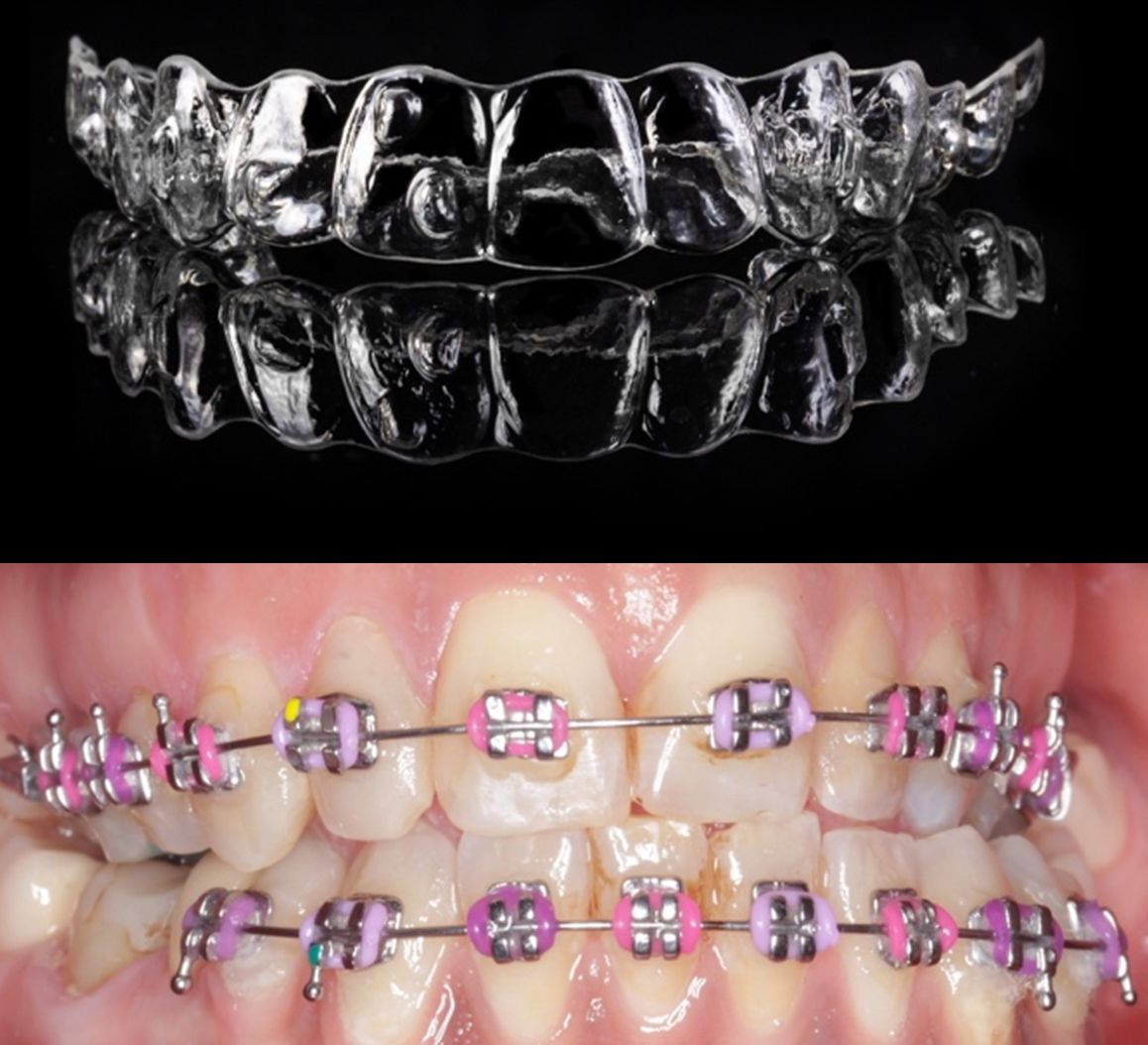 Brackets vs. Ortodoncia Invisible: ¿Cuál es la mejor opción para tu Ortodoncia?