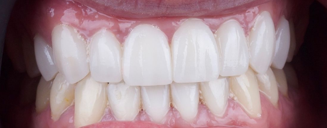 ¿Carillas de cerámica o carillas de resina? ¿Conoces las diferencias? dental morante implantes en madrid