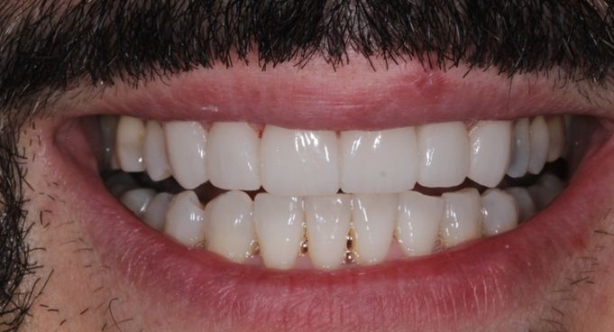 ¿Carillas de cerámica o carillas de resina? ¿Conoces las diferencias? dental morante implantes en madrid