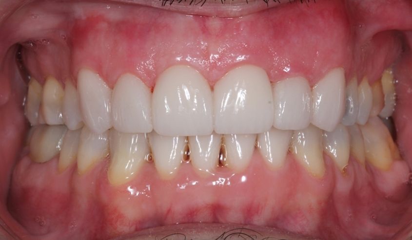 ¿Carillas de cerámica o carillas de resina? ¿Conoces las diferencias? dental morante implantes en madrid