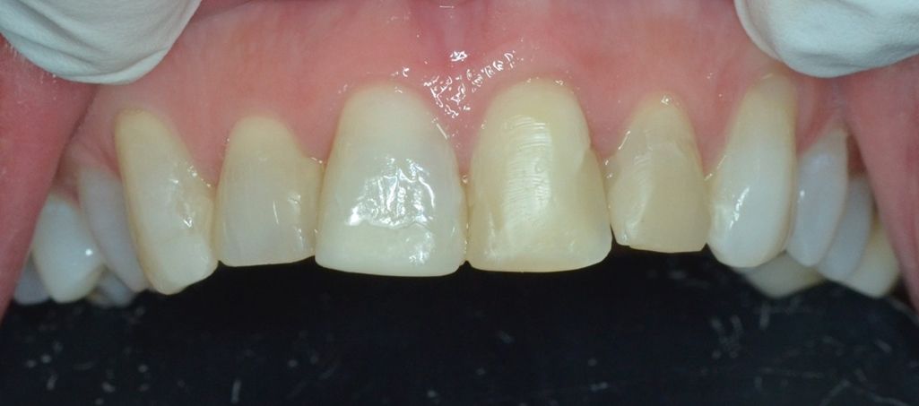 ¿Carillas de cerámica o carillas de resina? ¿Conoces las diferencias? dental morante implantes en madrid