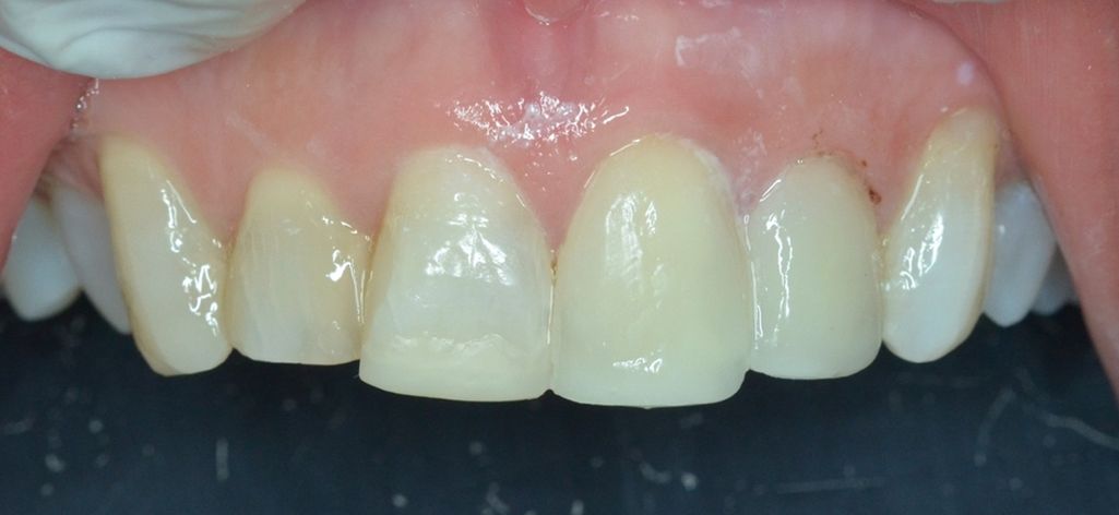 ¿Carillas de cerámica o carillas de resina? ¿Conoces las diferencias? dental morante implantes en madrid