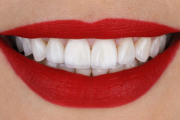 ¿Carillas de cerámica o carillas de resina? ¿Conoces las diferencias?