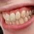 Cómo eliminar las manchas blancas de los dientes