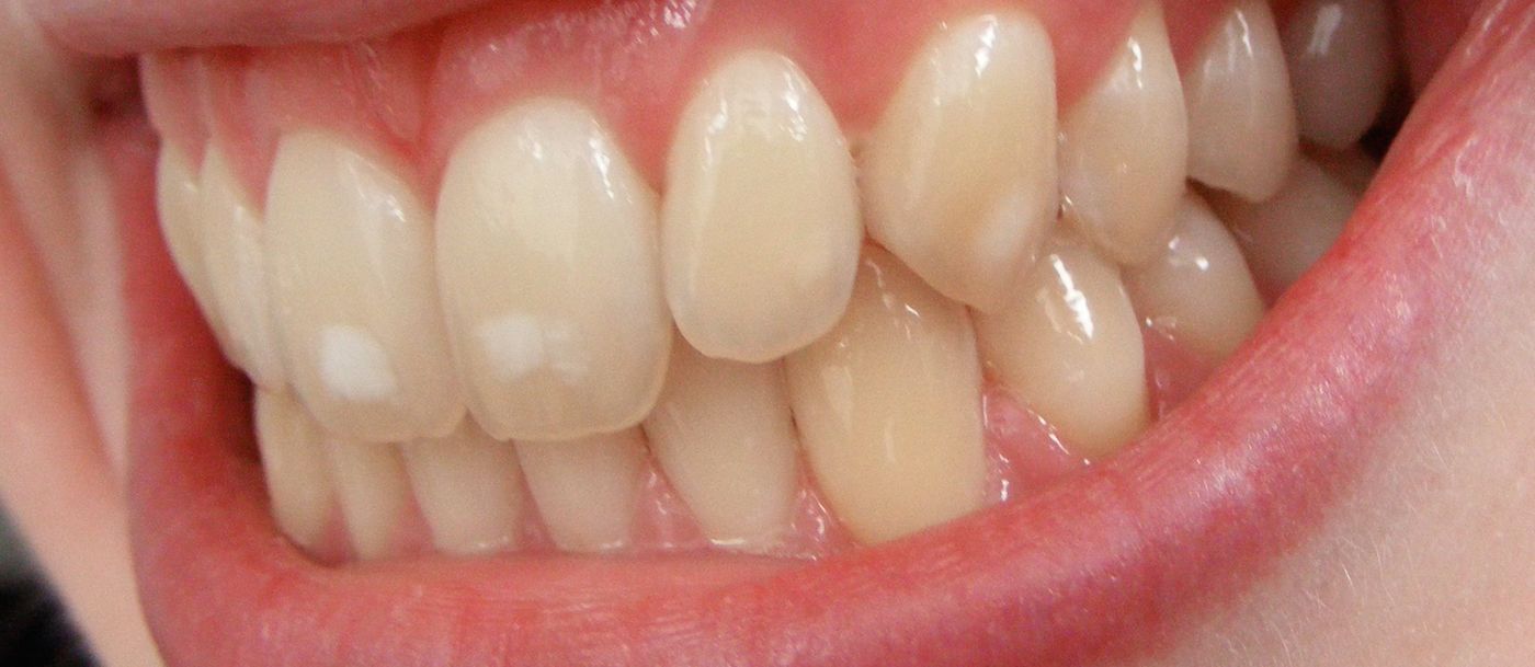 Cómo eliminar las manchas blancas de los dientes