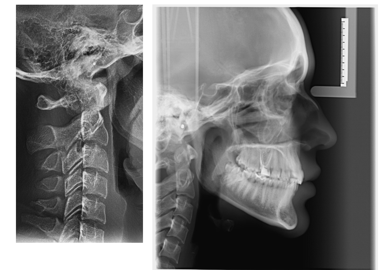 ¿Sabías que podemos conocer la edad ósea de una persona observando la forma de sus vértebras cervicales en una radiografía?
