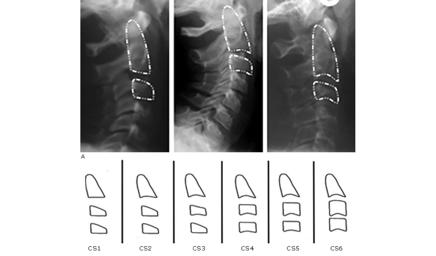 ¿Sabías que podemos conocer la edad ósea de una persona observando la forma de sus vértebras cervicales en una radiografía?