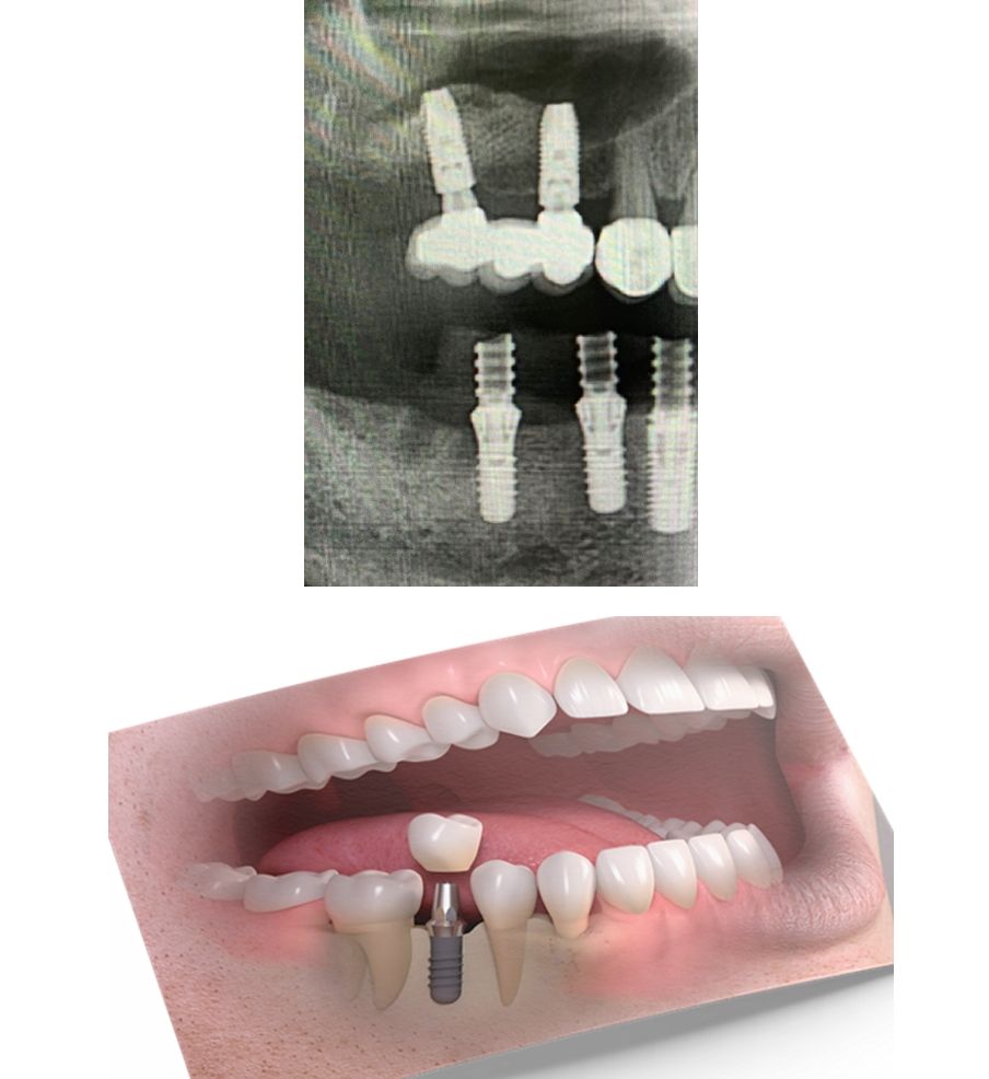 Cuánto tiempo transcurre desde que necesitamos un implante hasta que tenemos implante y corona en boca