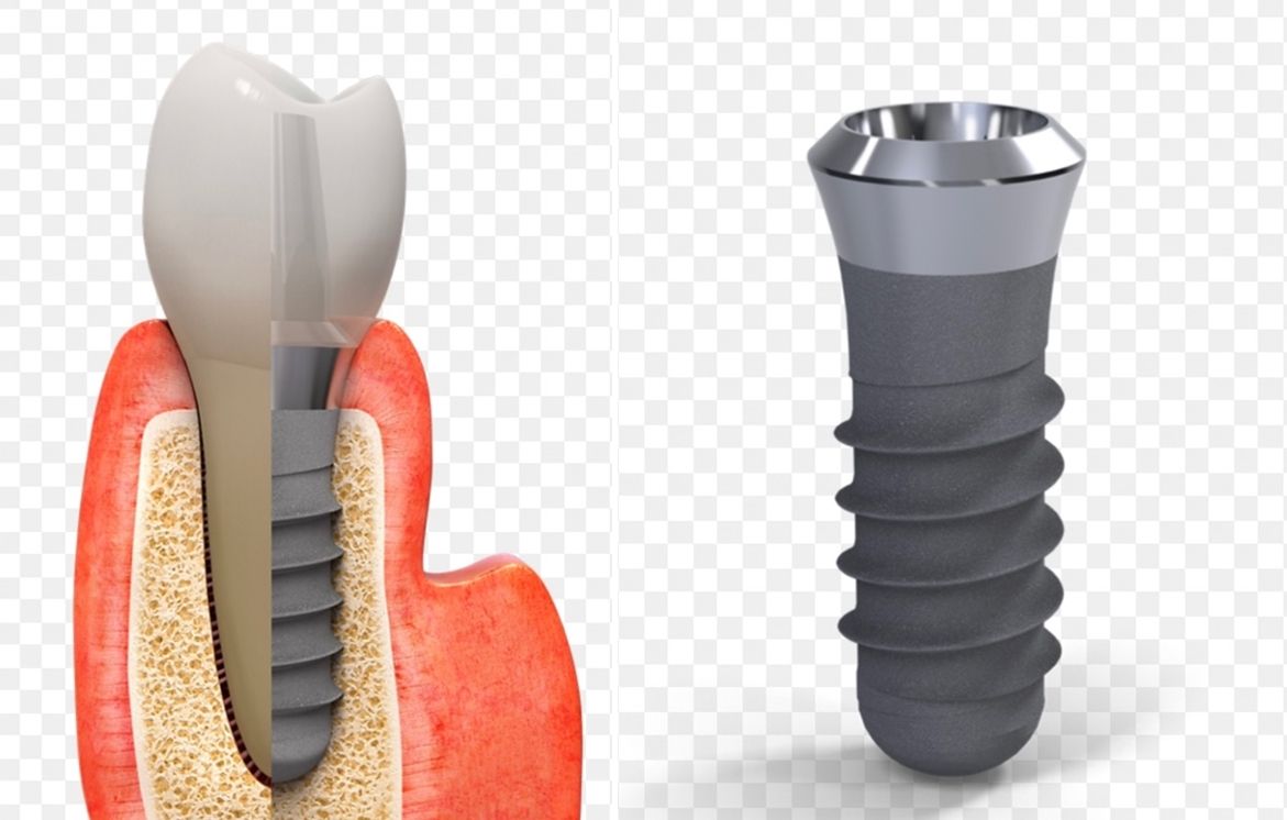 ¿Cuánto tiempo transcurre desde que necesitamos un implante hasta que tenemos implante y corona en boca?