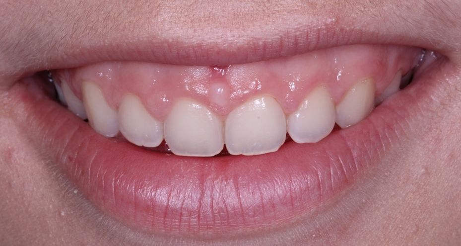 ¿Conoces las diferencias entre gingivectomía vs alargamiento coronario? dental morante implantes en madrid