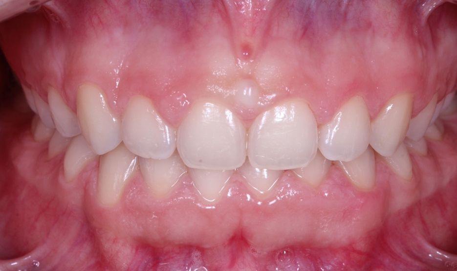 ¿Conoces las diferencias entre gingivectomía vs alargamiento coronario? dental morante implantes en madrid