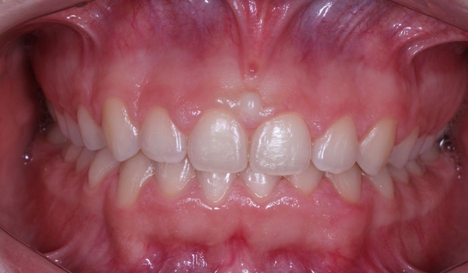 ¿Conoces las diferencias entre gingivectomía vs alargamiento coronario? dental morante implantes en madrid