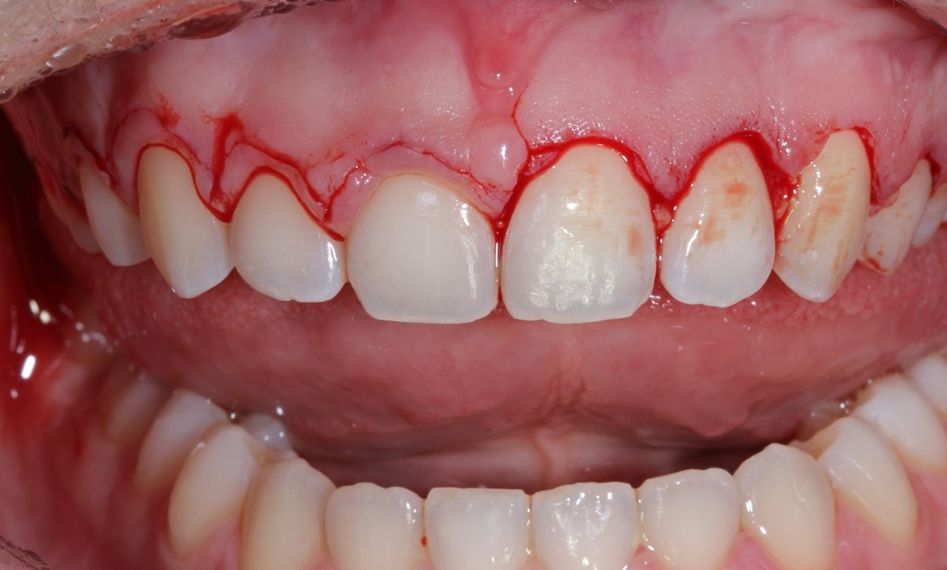 ¿Conoces las diferencias entre gingivectomía vs alargamiento coronario? dental morante implantes en madrid