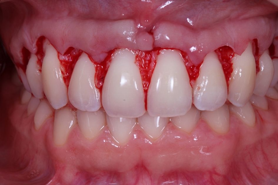 ¿Conoces las diferencias entre gingivectomía vs alargamiento coronario? dental morante implantes en madrid