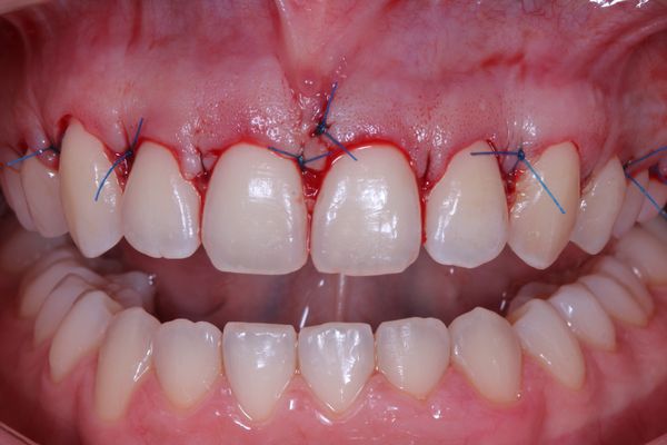 ¿Conoces las diferencias entre gingivectomía y alargamiento coronario?