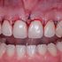 ¿Conoces las diferencias entre gingivectomía y alargamiento coronario?