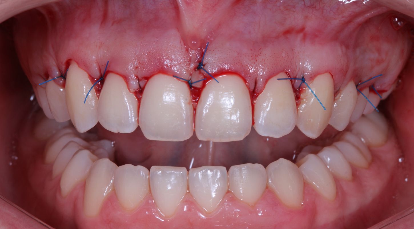 ¿Conoces las diferencias entre gingivectomía y alargamiento coronario?