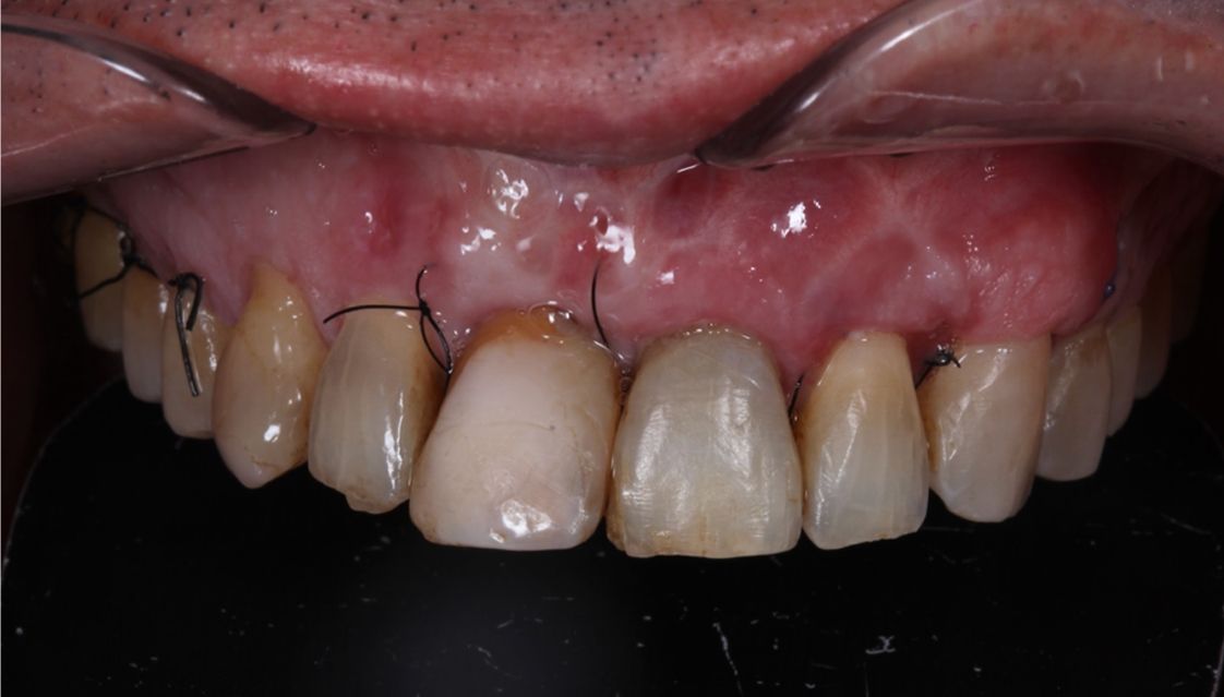 Qué es un tratamiento multidisciplinar en odontología dental morante implantes en madrid