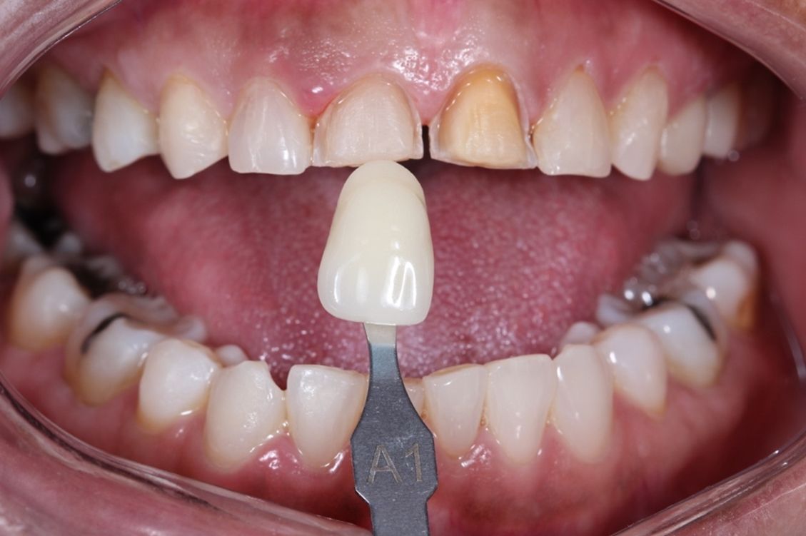 Qué es un tratamiento multidisciplinar en odontología dental morante implantes en madrid