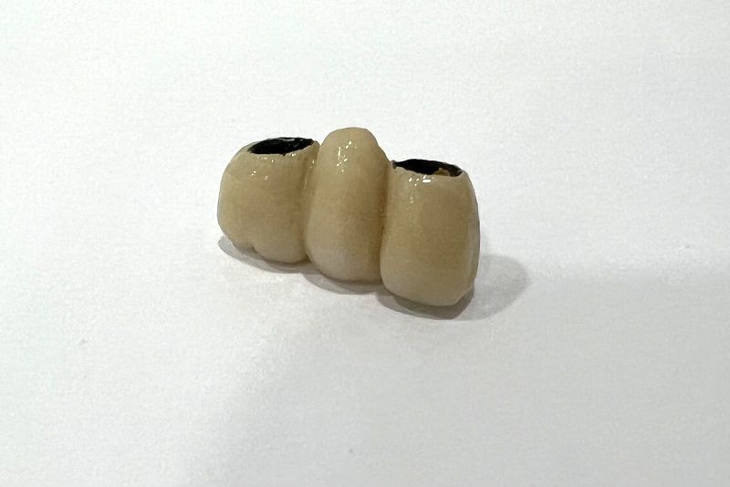 Implantes dentales vs puentes cuál es la mejor opción