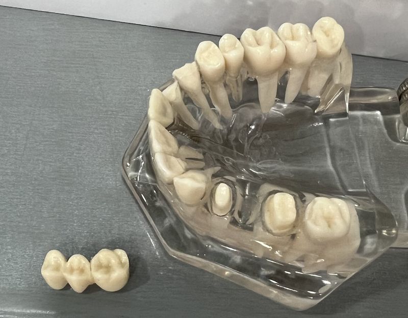 Implantes dentales vs puentes cuál es la mejor opción