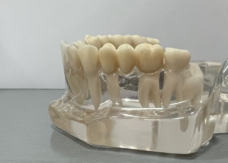 Implantes dentales vs puentes cuál es la mejor opción