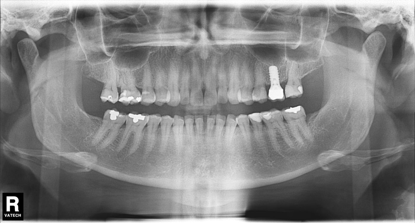 Implantes dentales vs puentes cuál es la mejor opción