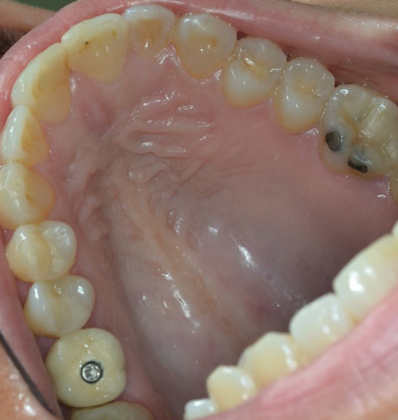 Implantes dentales vs puentes cuál es la mejor opción