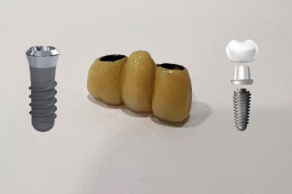 Implantes dentales vs puentes ¿cuál es la mejor opción?