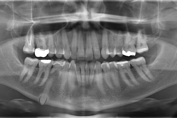 Un estudio refuerza la teoría sobre el origen del Alzhéimer: una infección en la boca