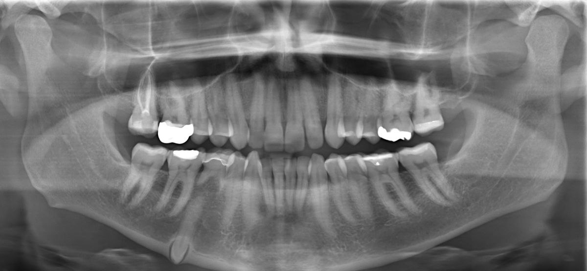 Un estudio refuerza la teoría sobre el origen del Alzhéimer: una infección en la boca