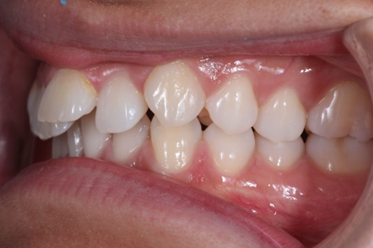 ¿A qué nos referimos cuando hablamos de Clase II?