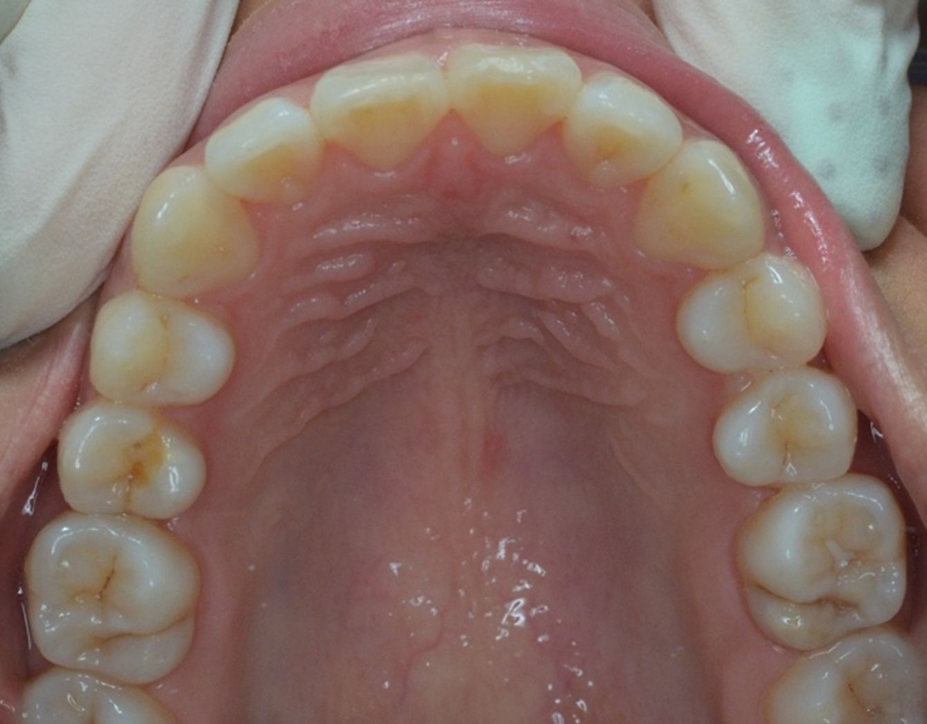 ¿A qué nos referimos cuando hablamos de Clase II?