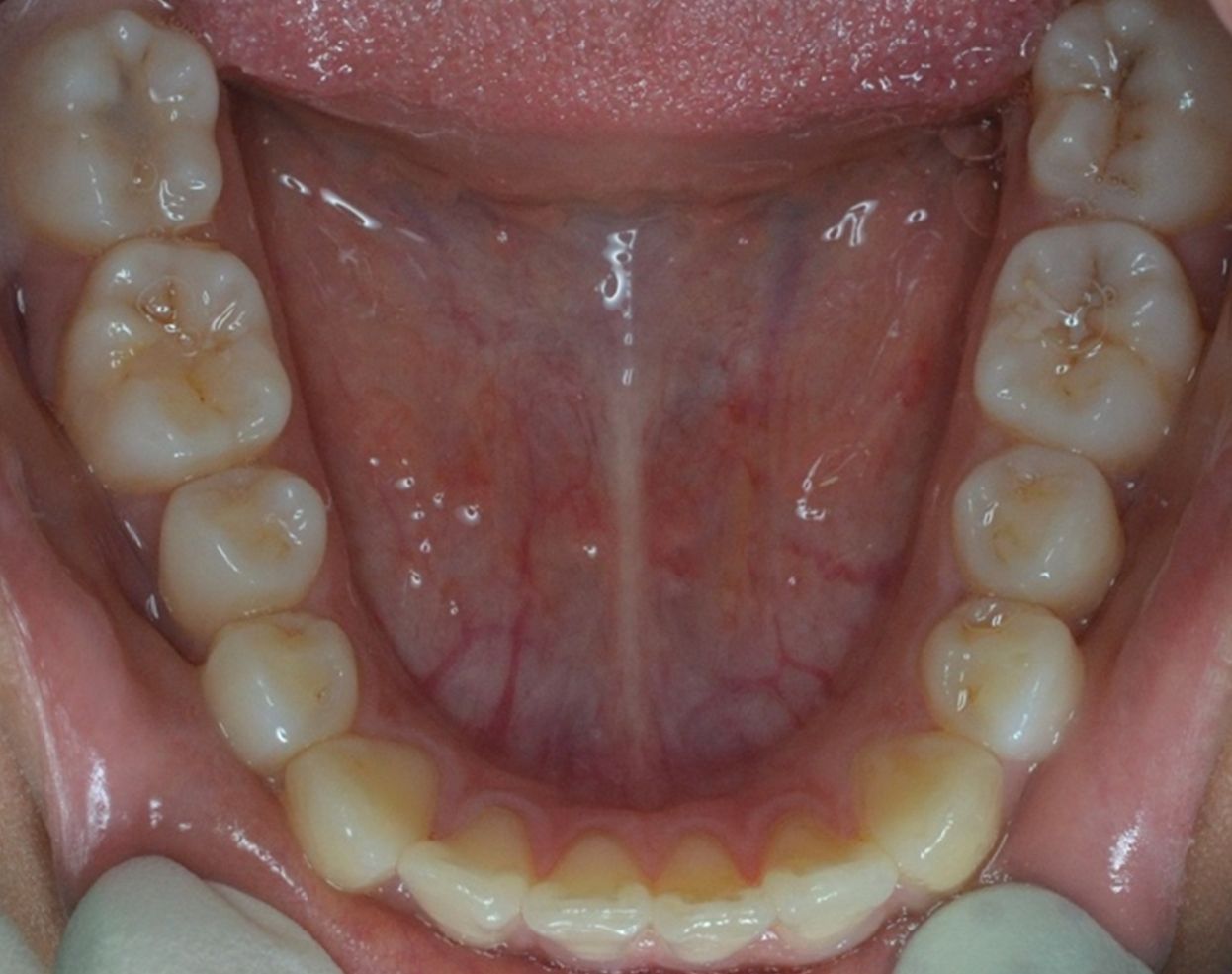 ¿A qué nos referimos cuando hablamos de Clase II?