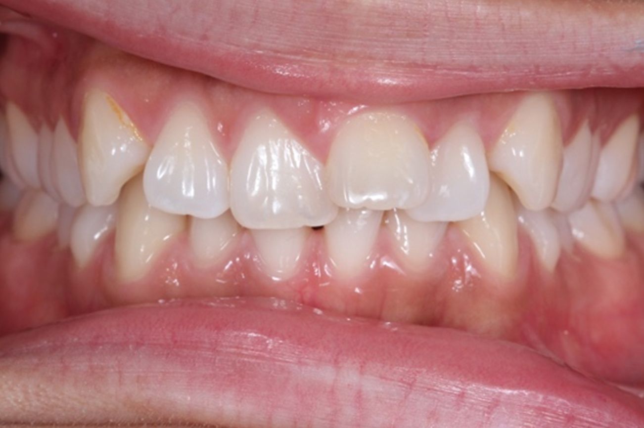 ¿A qué nos referimos cuando hablamos de Clase II?