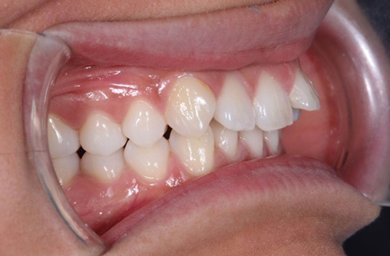 ¿A qué nos referimos cuando hablamos de Clase II?