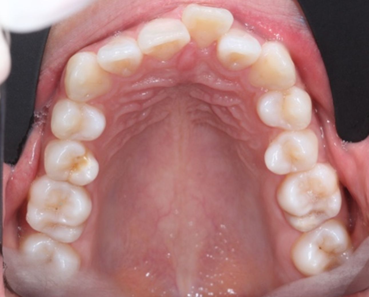 ¿A qué nos referimos cuando hablamos de Clase II?