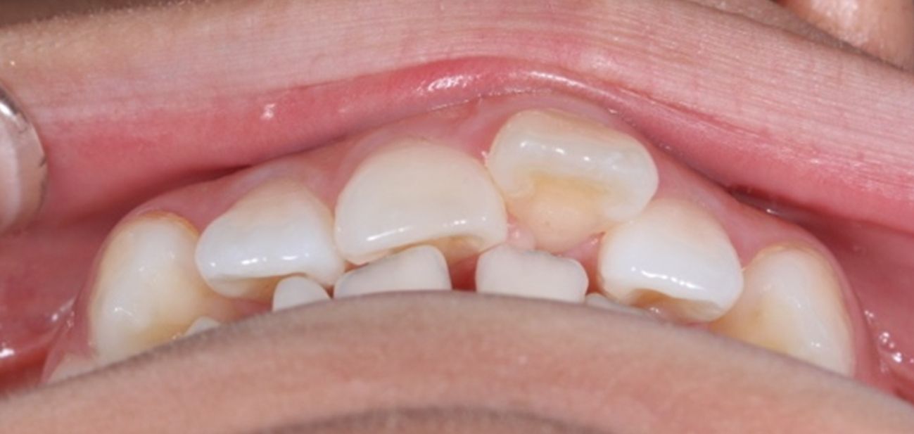 ¿A qué nos referimos cuando hablamos de Clase II?