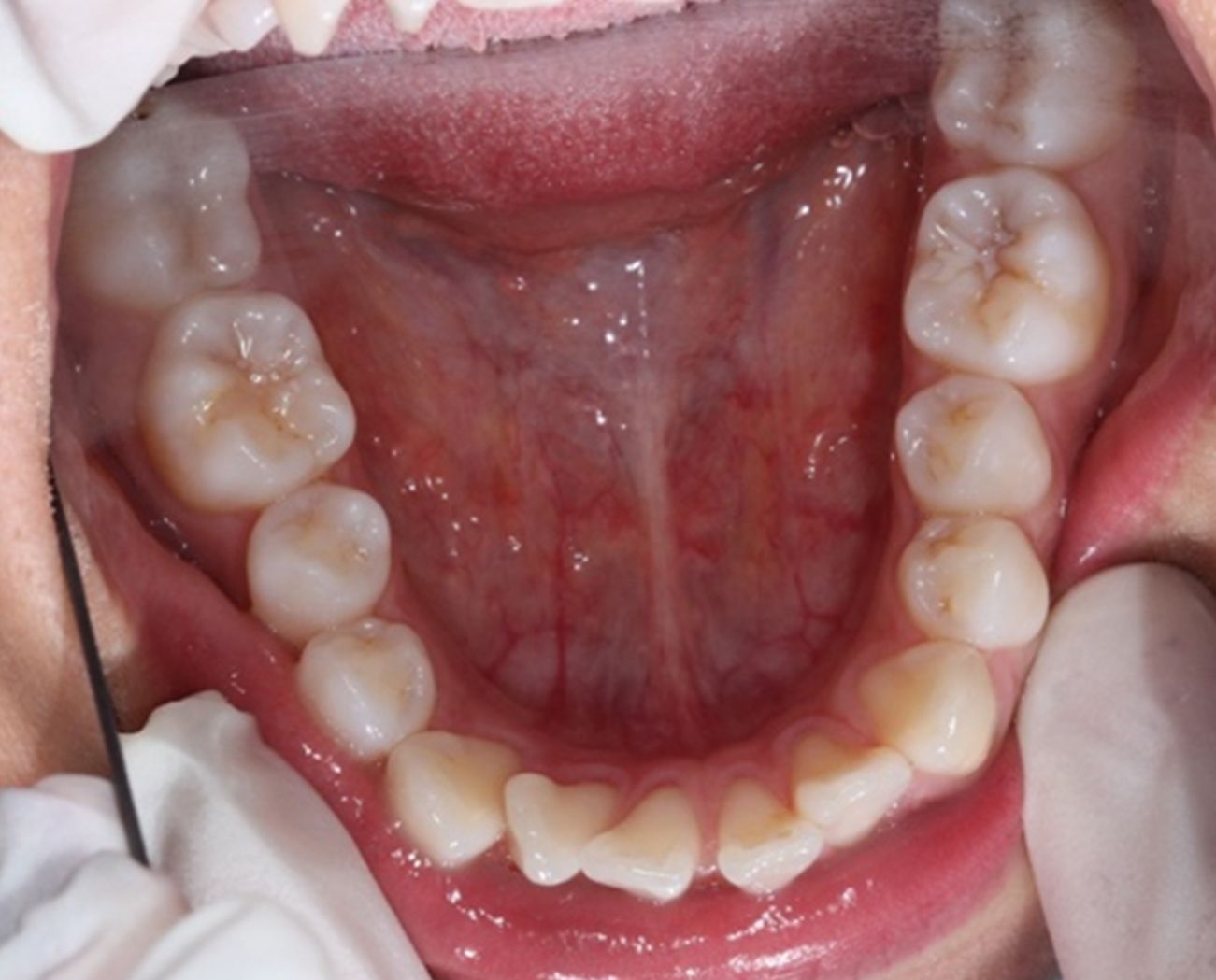 ¿A qué nos referimos cuando hablamos de Clase II?