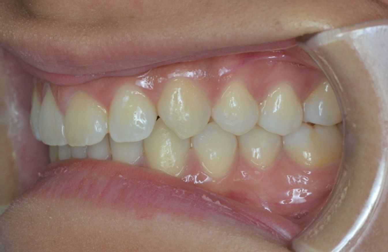 ¿A qué nos referimos cuando hablamos de Clase II?