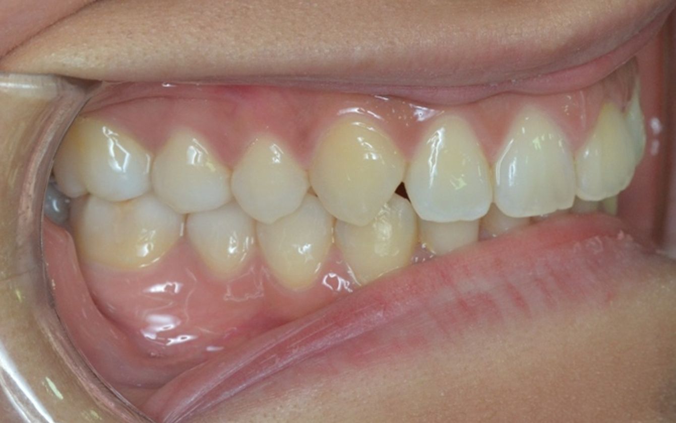 ¿A qué nos referimos cuando hablamos de Clase II?