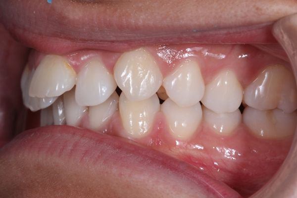 ¿A qué nos referimos cuando hablamos de Clase II?