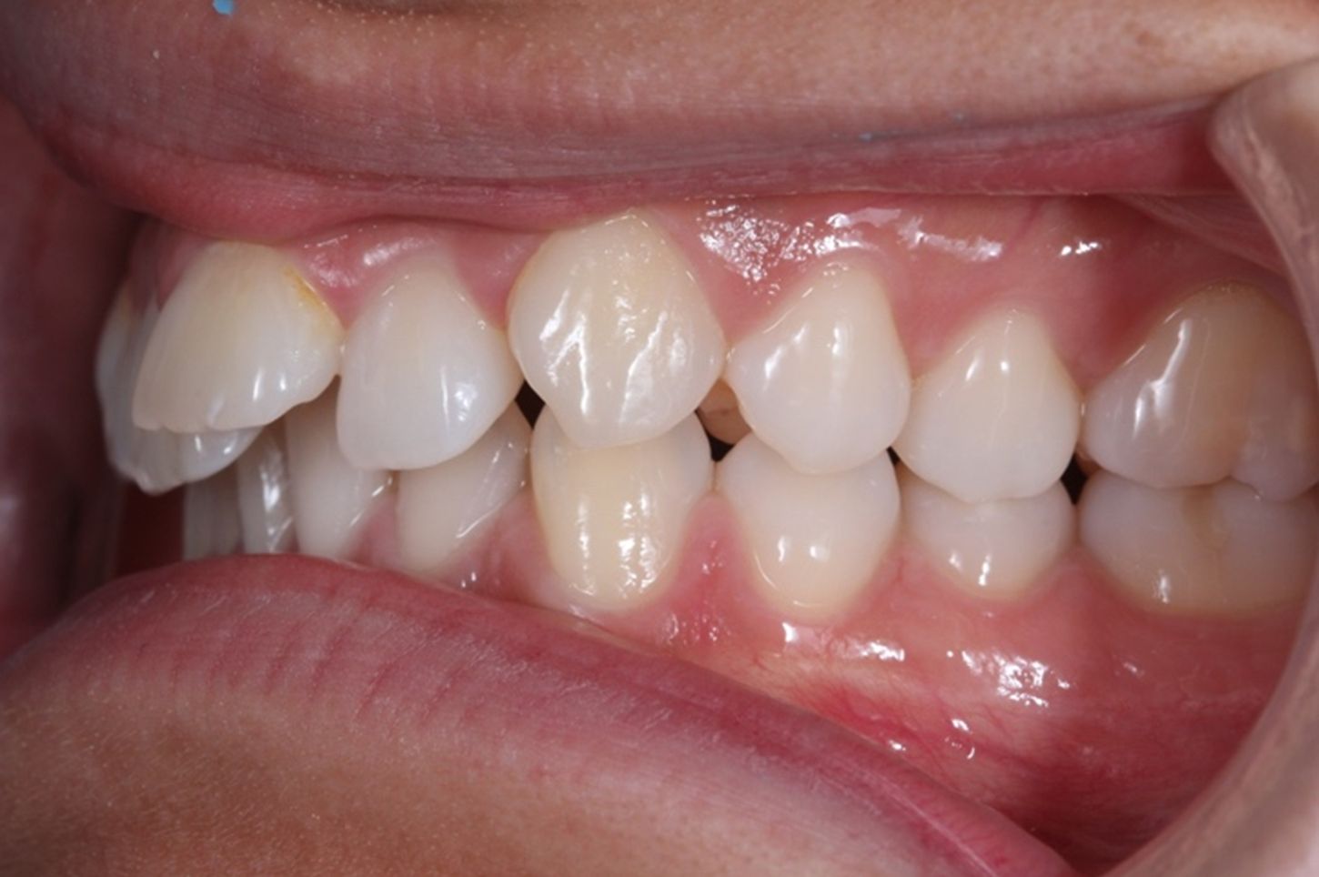 ¿A qué nos referimos cuando hablamos de Clase II?