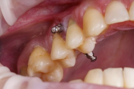 ¿Qué son los MINITORNILLOS? ¿Te han dicho que vas a llevarlos en tu tratamiento de ortodoncia?